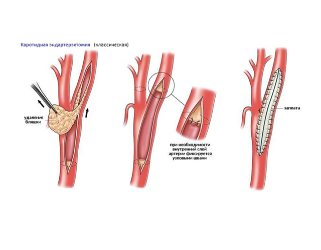 Атеросклероз сосудов шеи